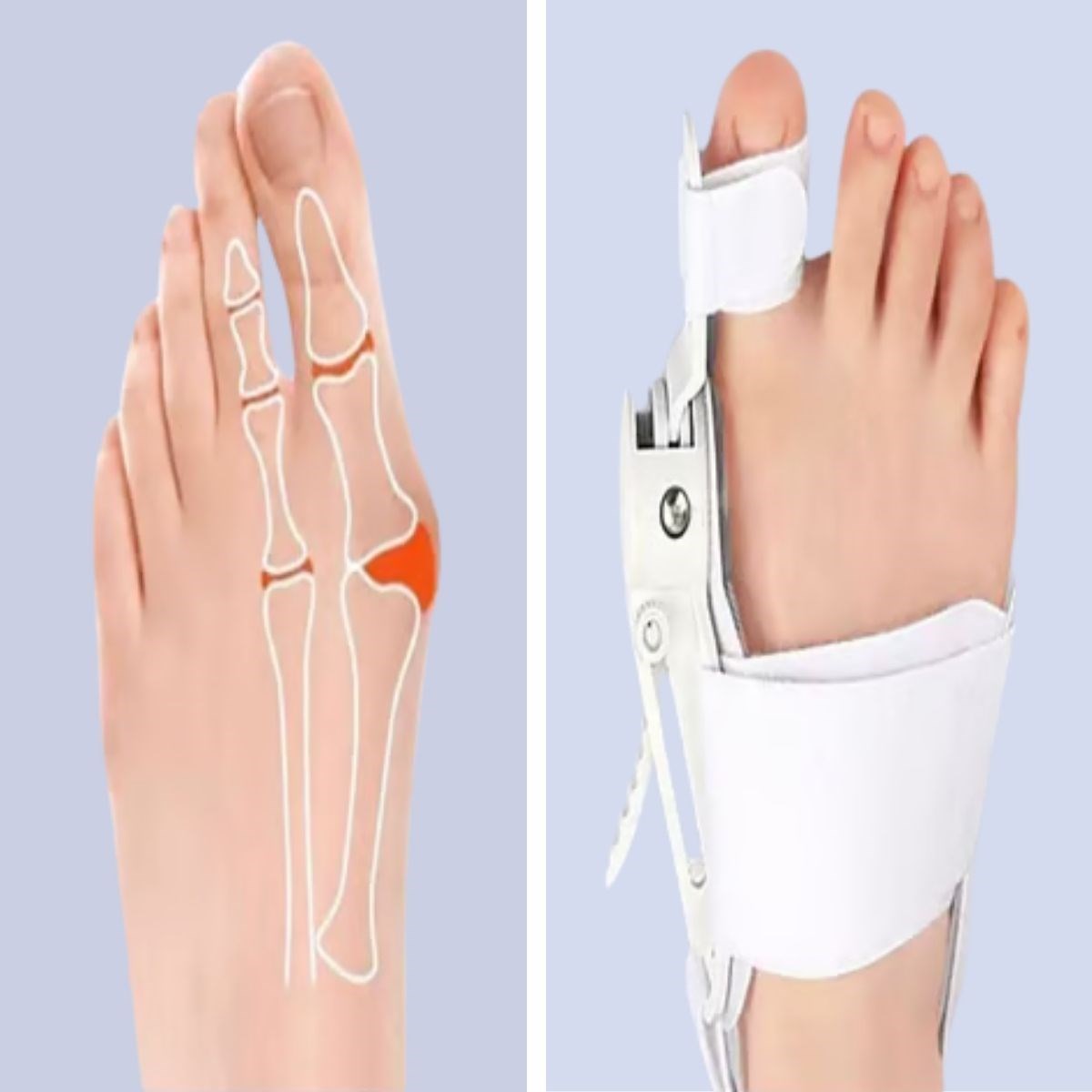Ayarlanabilir Ayak Baş Parmak Kemik Düzeltici – Halluks Valgus (Bunyon) Aparatı, Gece Gündüz Kullanıma Uygun Ayak Düzeltme Ateli (5538) 3